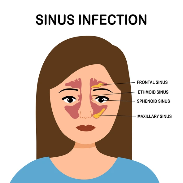 Sinus Infections