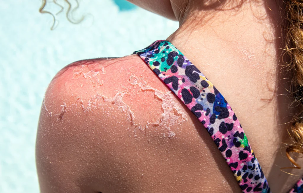 a girl with skin feeling off clearly with sun poisoning condition