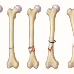 Diagram illustrating the bones of the leg at various stages.
