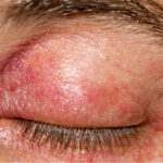 Close-up of a person's eye showing redness and red irritated skin around eyes, highlighting discomfort and inflammation.