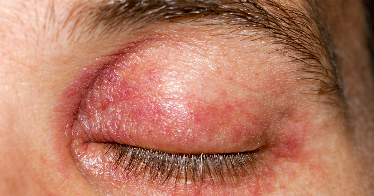 How to Soothe Irritated Skin Around Eyes