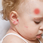 Toddler with visible head injury and red marks on skin, highlighting concern for toddler's head injury and related symptoms