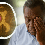 Elderly man holding his head in discomfort with a brain scan showing the affected area, representing symptoms and effects of a mini stroke