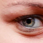 Under-eye swelling shown in close-up eye image.