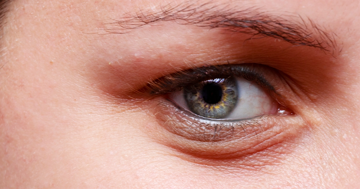 What Causes Swelling Under One Eye
