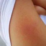 Skin irritation patch showing signs of moving itch discomfort.